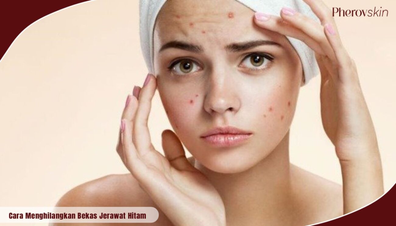 cara menghilangkan bekas jerawat hitam