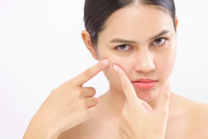 mengenali milia pada wajah