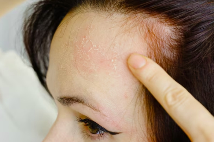 cara menghilangkan bruntusan