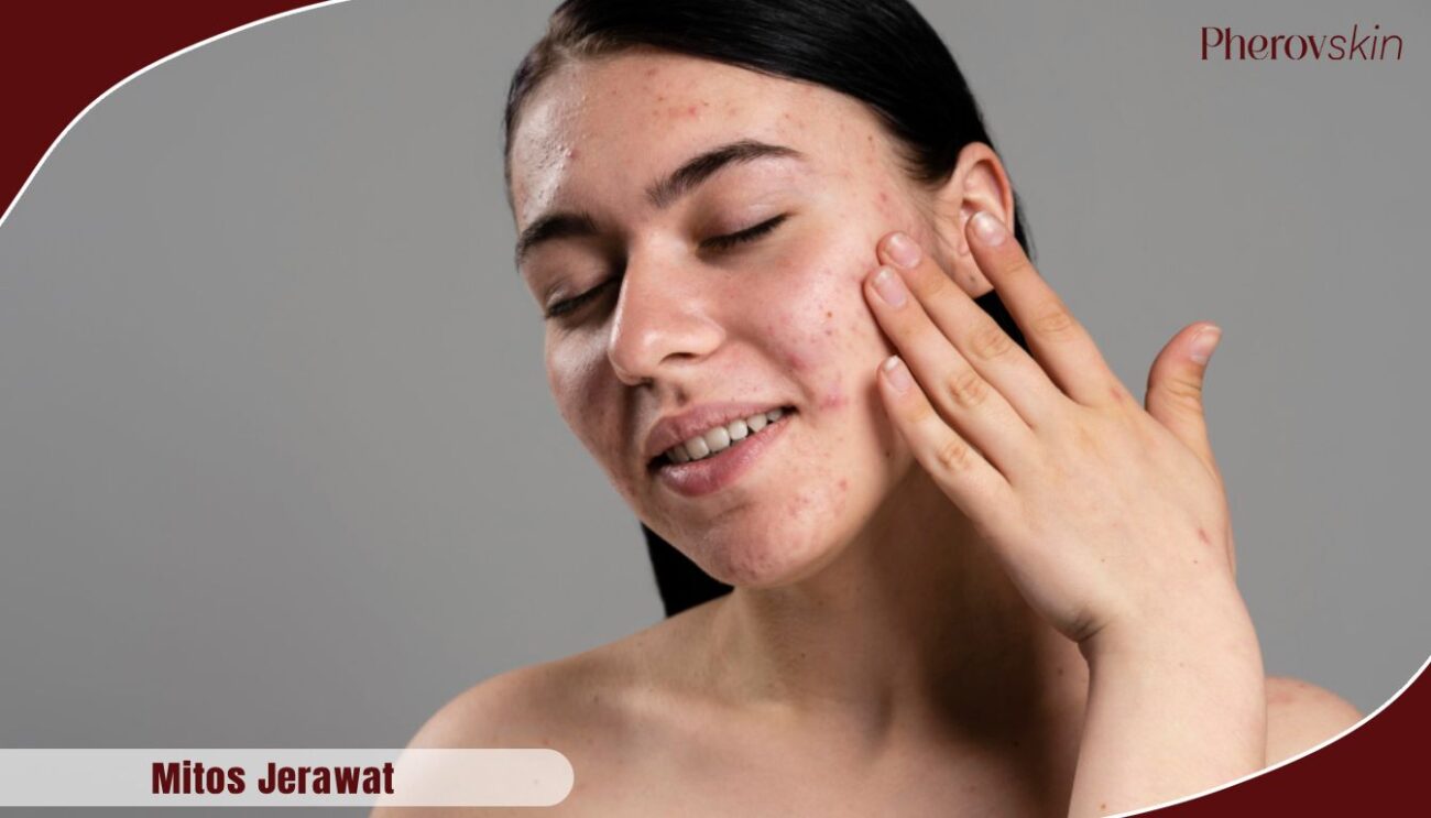 mitos jerawat