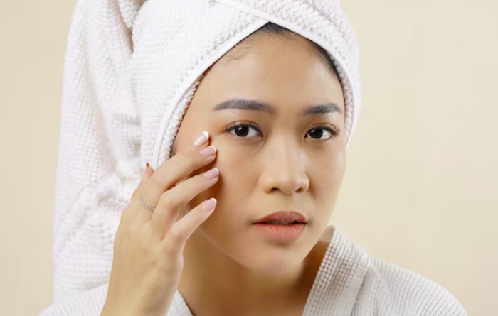 tips menghilankan milia